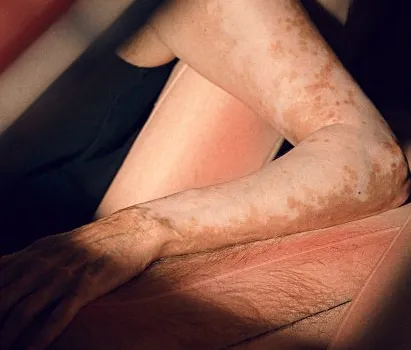 TBWA\Eleven Crafts the "Sunburnt Car": Awakening Consumer Vigilance Against UV Exposure with Human-Like Skin